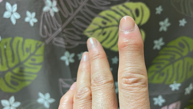 変形性関節症の指
